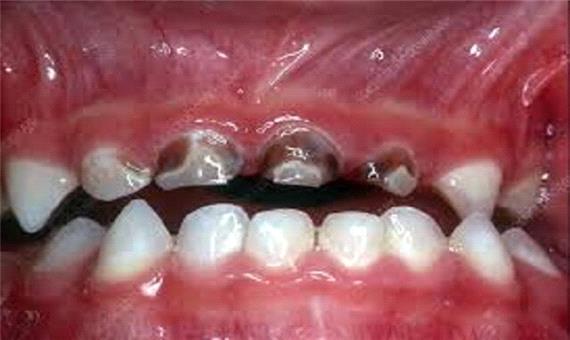 افزایش خطر ابتلا به سرطان‌های دستگاه گوارش فوقانی با پوسیدگی‌های دندانی