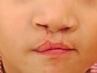 جراحی رایگان شکاف لب در یزد