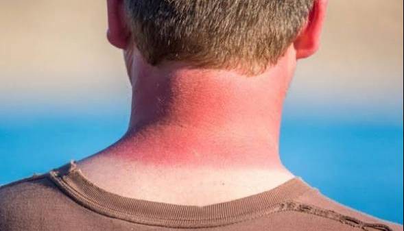 تنها یک آفتاب‌سوختگی شدید می‌تواند سلامت ما را برای همیشه تغییر دهد | آخرین خبر